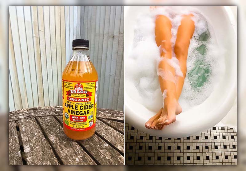 Apple Cider Vinegar for Mosquito Bites 