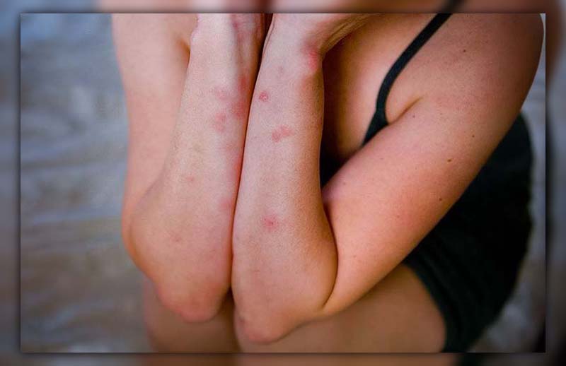 Difference Between Mosquito Bite and Bed Bug Bite