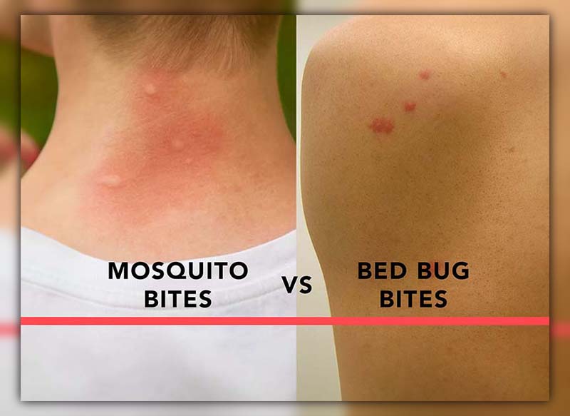 Difference Between Mosquito Bite and Bed Bug Bite 