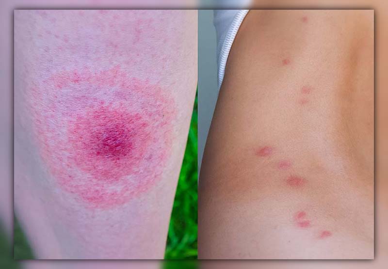 Difference Between Mosquito Bite and Spider Bite