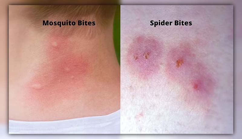 Difference Between Mosquito Bite and Spider Bite