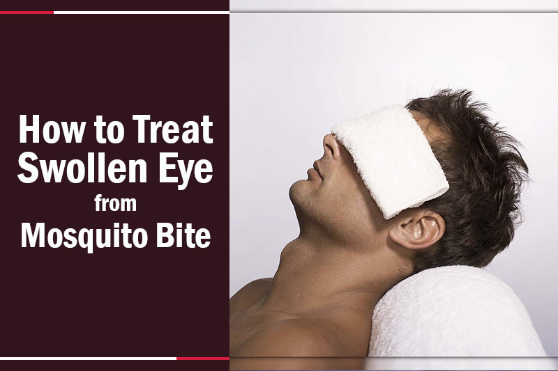 How to Treat Swollen Eye from Mosquito Bite
