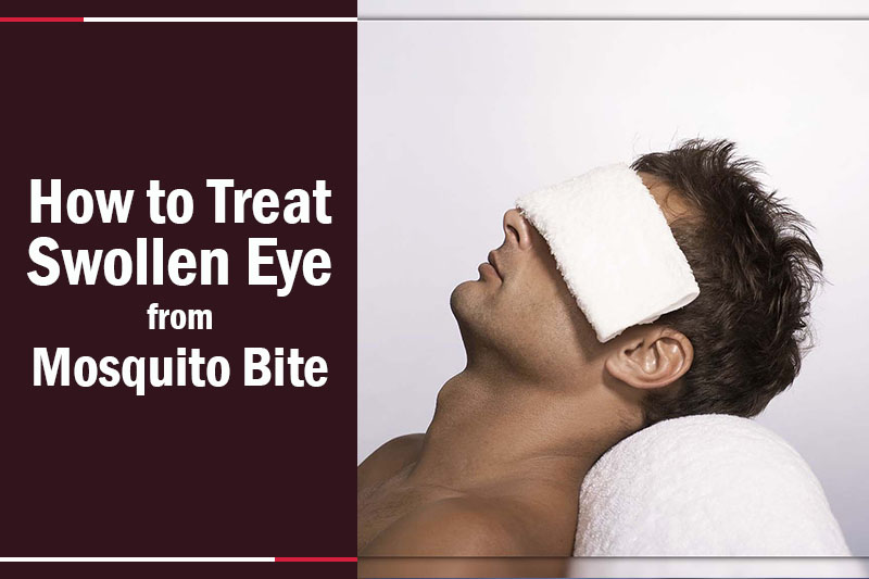 how-to-treat-swollen-eye-from-mosquito-bite-fast-relief-tips