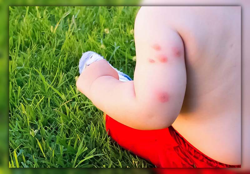 Why Does My Child Get So Many Mosquito Bites 