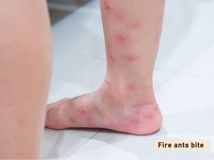 Fire ant bites on the skin picture