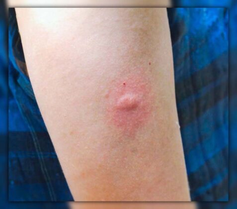 Difference Between Mosquito Bite and Bed Bug Bite