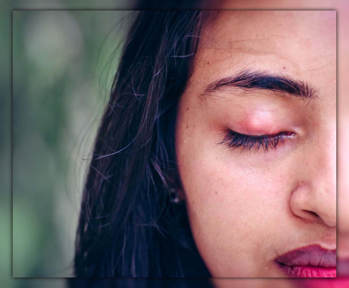 how-to-treat-swollen-eye-from-mosquito-bite-fast-relief-tips